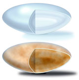 A01 cataracts