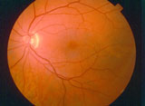 A01 cataracts