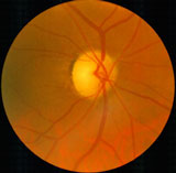 A01 cataracts